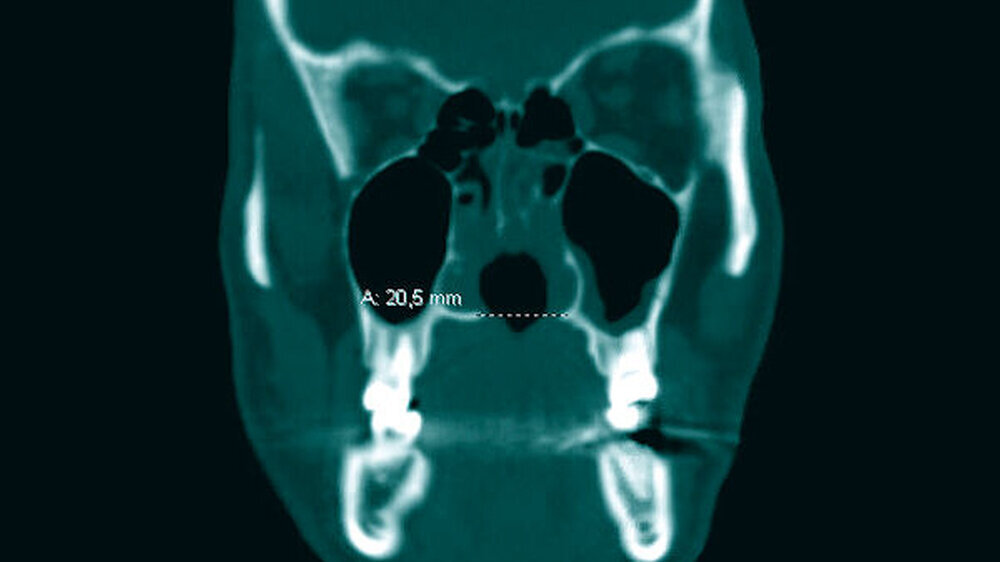 Abb. 1: CT Mittelgesicht, koronare Ebene im Knochenfenster: Markiert ist der Defekt (circa 2 cm) im Hartgaumen.