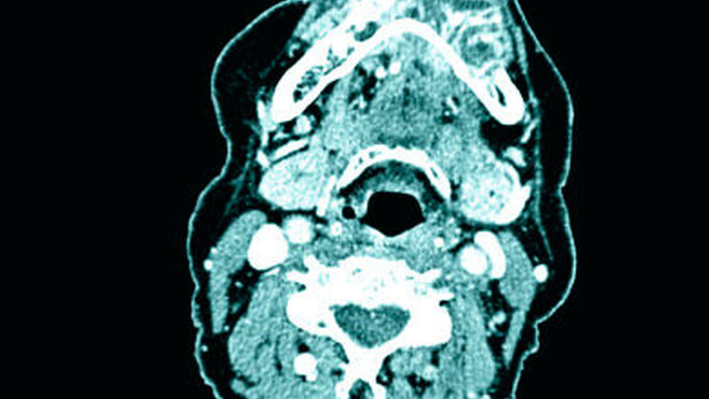 Abbildung 2: Präoperative CT-Bildgebung mit osteolytisch-osteoblastischer Raumforderung im Bereich des anterioren Unterkiefers mit Resorption der Außenkortikalis regio 35/36 bis 45/46 |