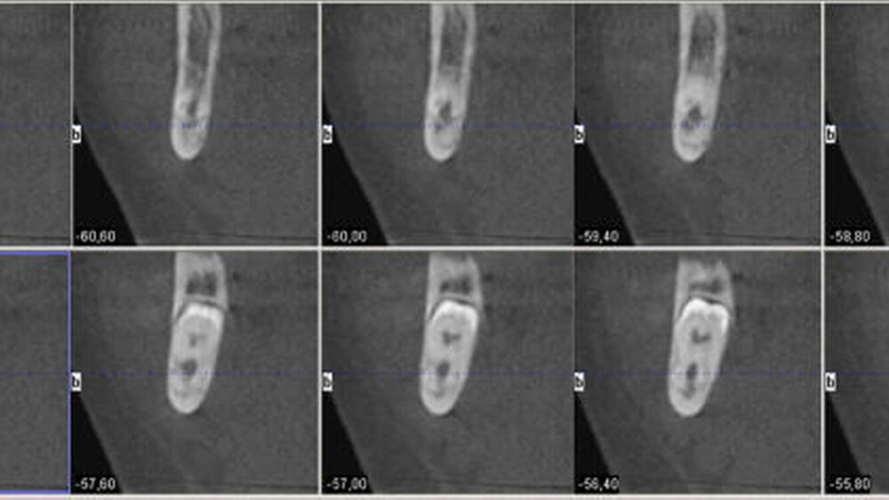 Abbildung 4: In der analogen Ansicht für Zahn 48 ist hingegen eine Fusion der Wurzeln zu erkennen. |
