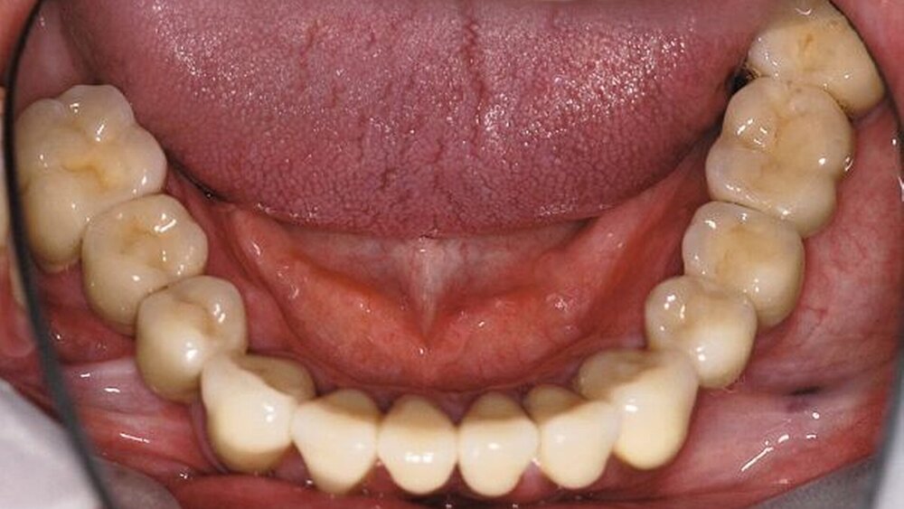 Abbildungen 16a, 16b, 16c, 16d, 16e: Abschlussbefund (definitiv befestigte Kronen und Brücken sowie eingegliederte partielle obere Prothese). |