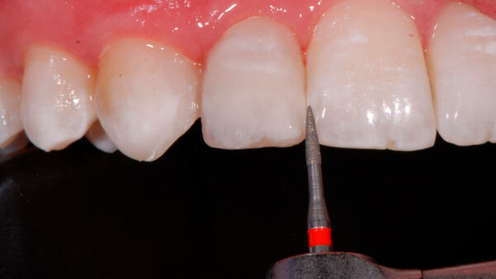 Abbildung 8: Ausarbeitung mittels De Trey Enhance ® Finishing System \r\n