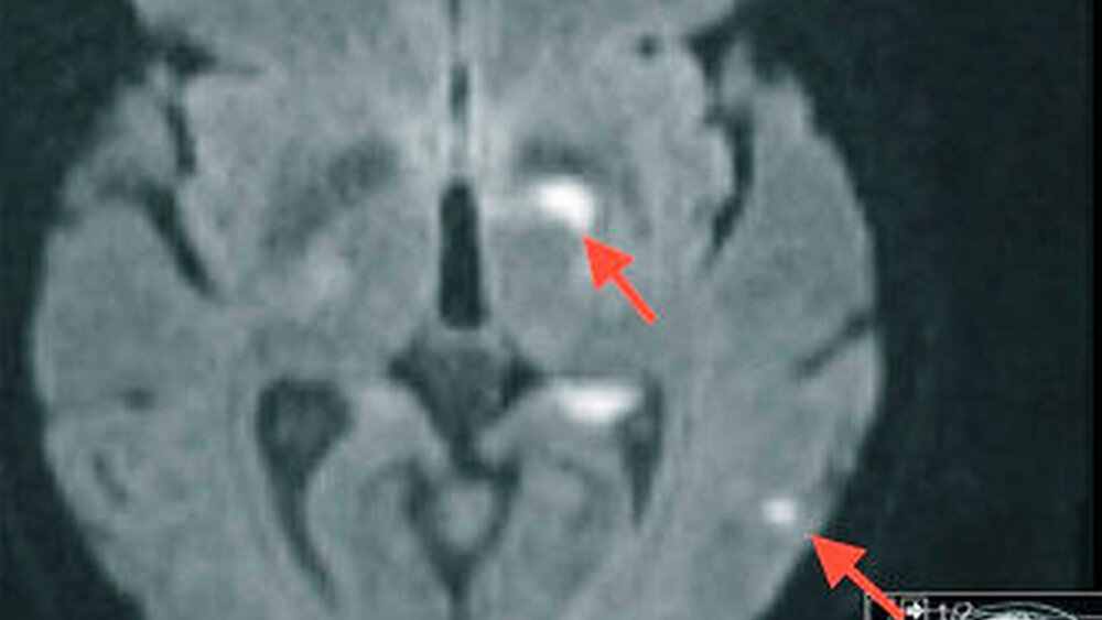 Abbildung 2: Angiographische Darstellung während der Thrombektomie und Lyse |