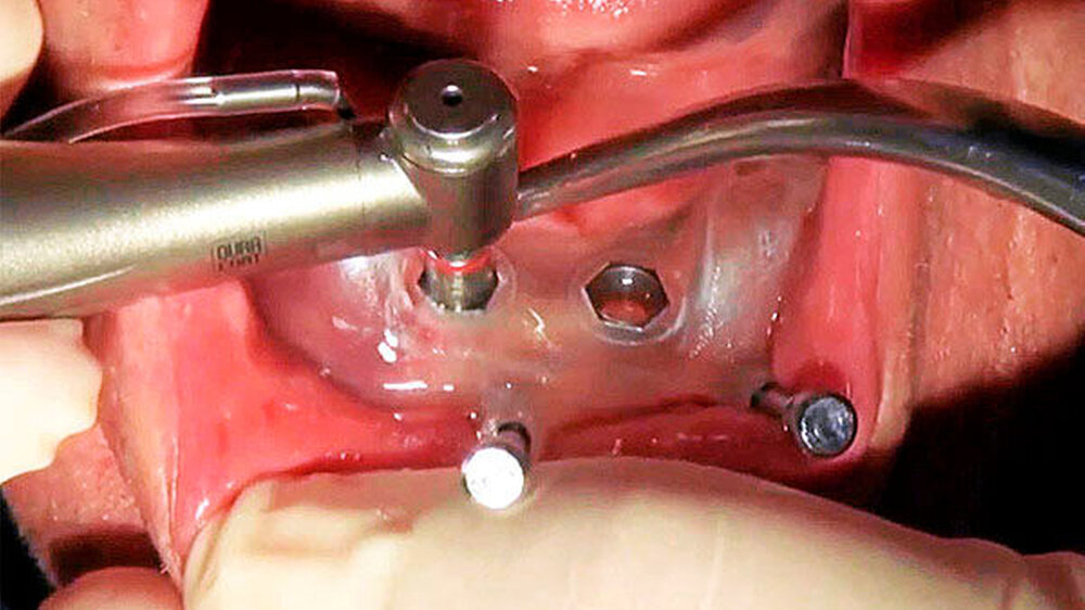In nur einer Sitzung tauscht Dr. Malte Otte eine bestehende, festsitzende Brücke im Oberkiefer gegen eine provisorische Sofortversorgung mit der ICX-Smile Bridge auf sechs Implantaten.