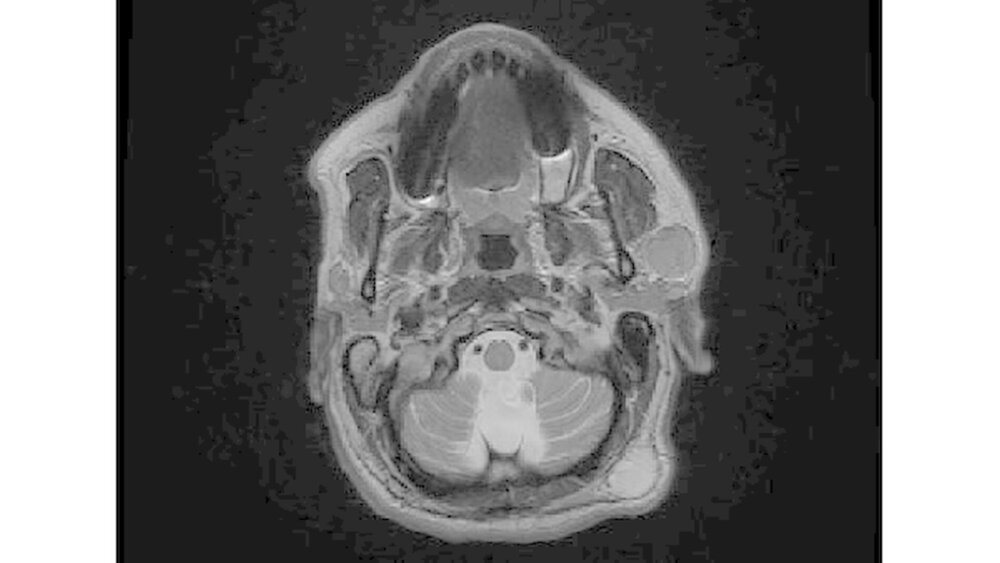 148643-flexible-1900 Abbildung 1b: MRT Kopf-Hals: axiale T2-gewichtete Aufnahme mit homogen erscheinender Raumforderung im linken oberflächlichen Parotislappen |