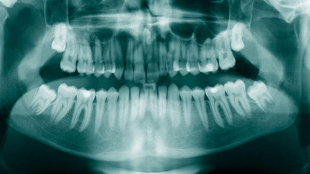 Abbildungen 5: Mesiodens bei einem 14-jährigen Patienten, welcher als radiologischer Zufallsbefund vor kieferorthopädischer Behandlung diagnostiziert wurde (Panoramaschichtaufnahme). |