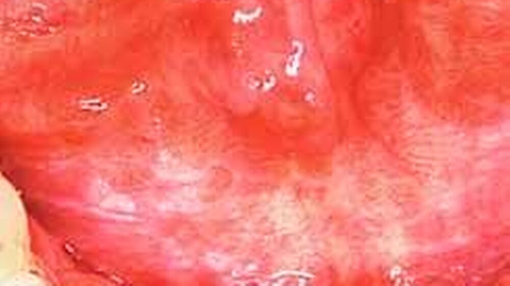 Homogene Leukoplakie des Mundbodens