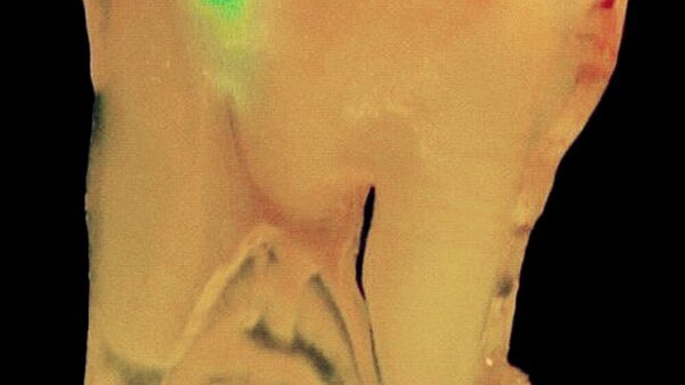 Abbildung 1: Diagnostisch nutzbare Fluoreszenzeffekte bei Abtragung von Dentin mithilfe der Ultrakurzpulslaser-Technologie