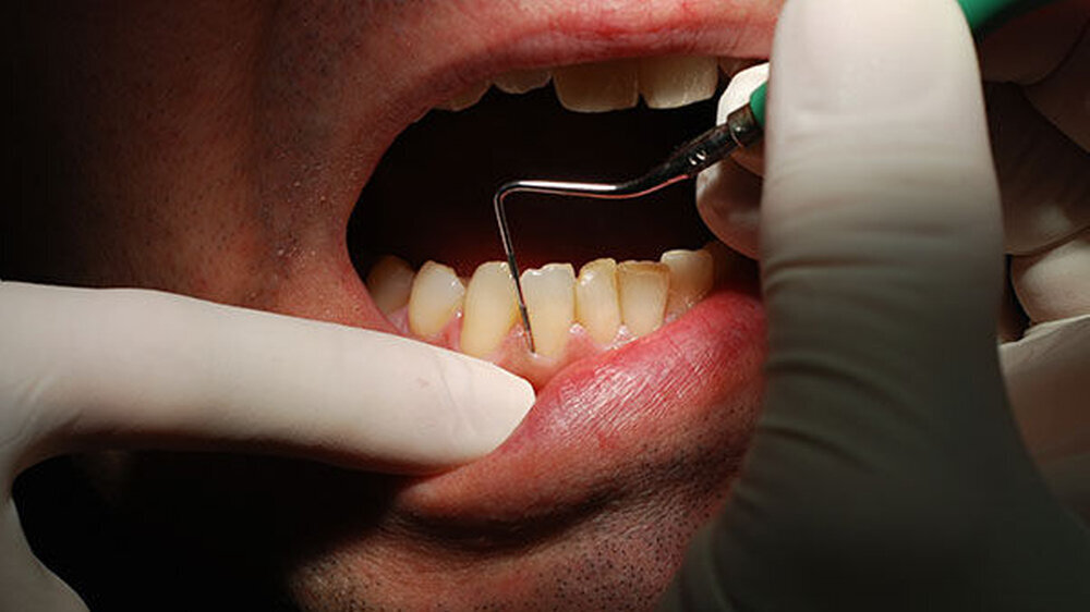 Thailändische Forscher haben in einer Querschnittsstudie bei Patienten mit chronischer Parodontitis (CP) reduzierte TFF3-Peptidkonzentrationen im Speichel nachgewiesen.