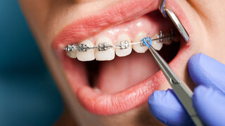 Close up of woman with brackets receiving dental braces treatment in clinic. Orthodontist using dental mirror and forceps while putting orthodontic braces on patient teeth. Concept of dentistry.