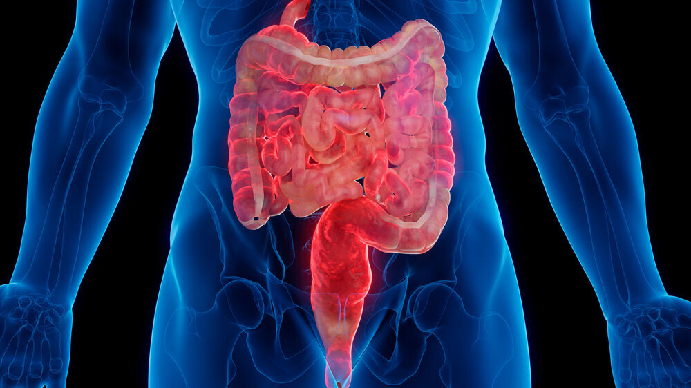 Medizinische 3D-Darstellung des Darms eines Mannes, der von Morbus Crohn betroffen ist