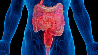 Medizinische 3D-Darstellung des Darms eines Mannes, der von Morbus Crohn betroffen ist