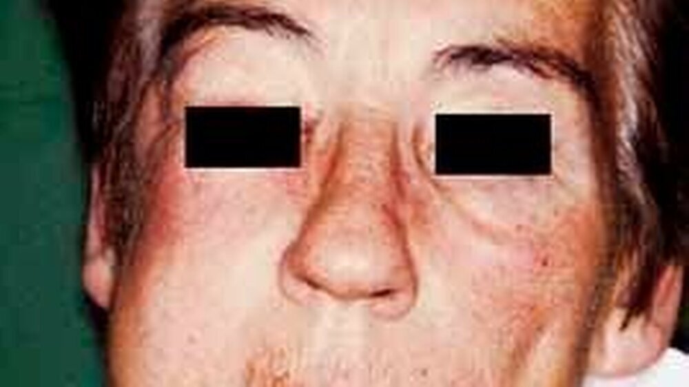 64-jährige Patientin mit massiver Gesichtsschwellung rechts und Luftnot als unmittelbare Folge endodontischer Behandlung alio loco