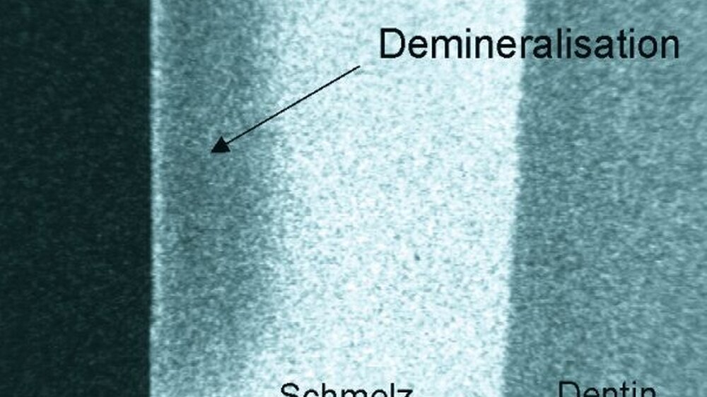 TMR-Bild mit einer im bovinen Schmelz erkennbaren Demineralisation