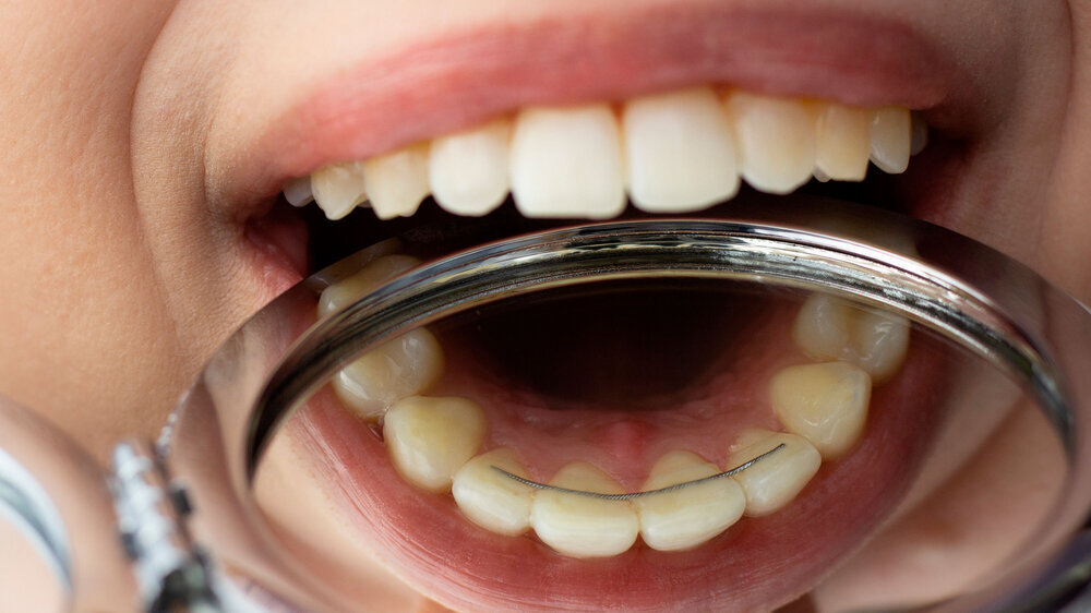Closeup of a permanent bonded retainer on upper teeth. Retainer
