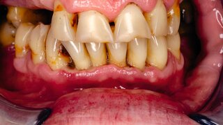 Akute Parodontitis mit tiefen Zahnfleischläsionen