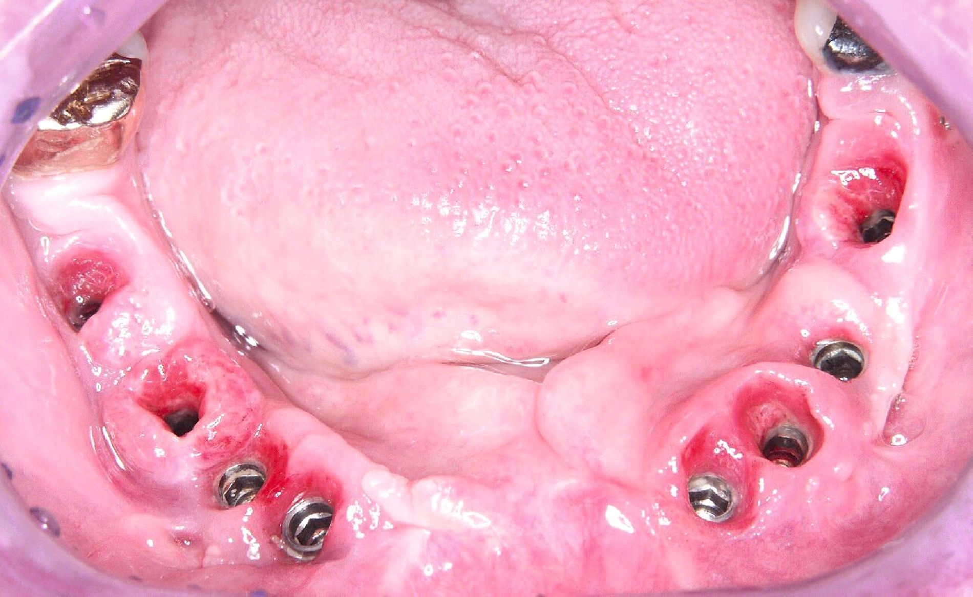 Abb. 1b: Deutliche Rötung der periimplantären Weichgewebe mit geringer Blutungsneigung nach Entfernen der verschraubten Suprakonstruktion