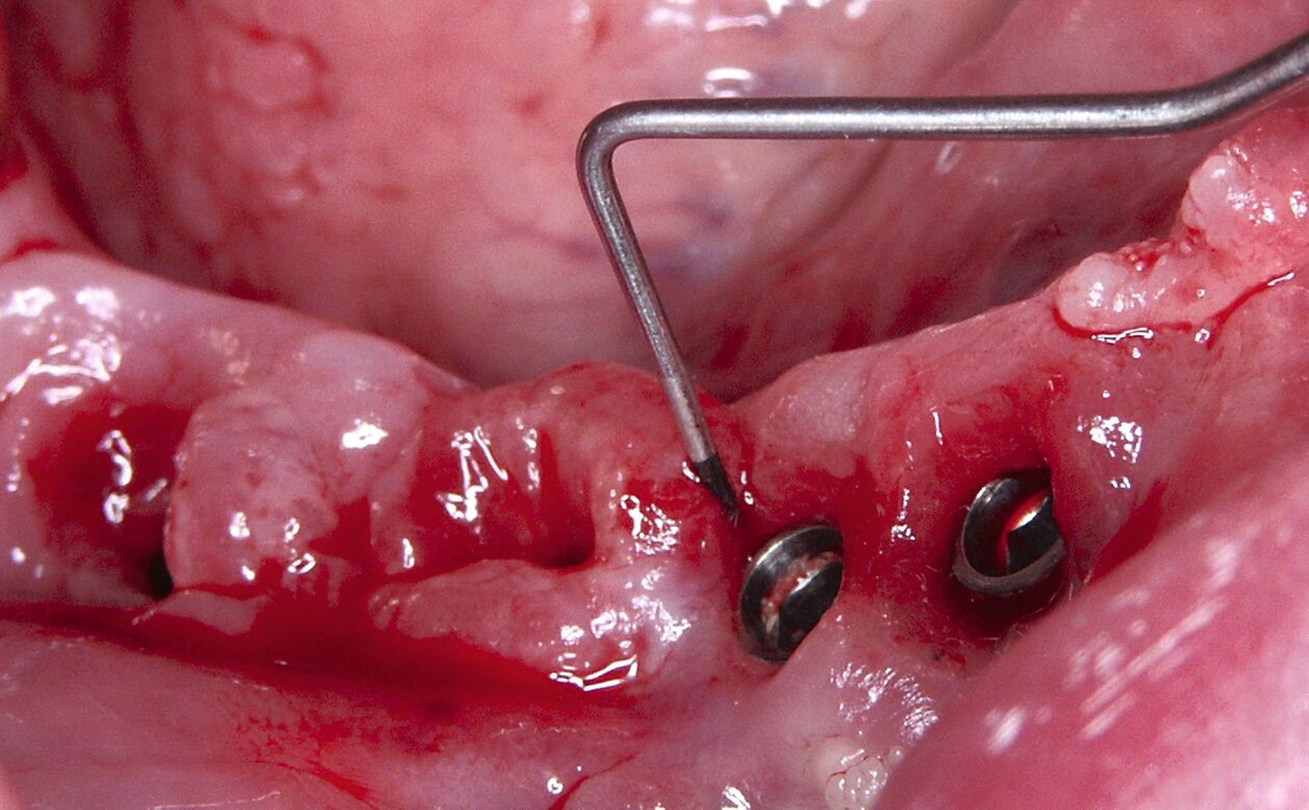 Abb. 1c: Bei Sondierungstiefen bis zu 12 mm und marginalem Knochenabbau bis zu 9 mm fällt die Entscheidung zur Explantation, um den Knochenabbau zu stoppen.