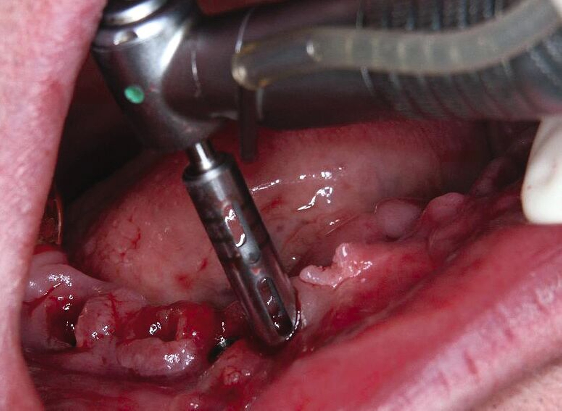 Abb. 1d: Die Entfernung erfolgte mit einem passenden Trepanbohrer (Innendurchmesser 0,1mm > Implantatdurchmesser) mit Längenmarkierung.