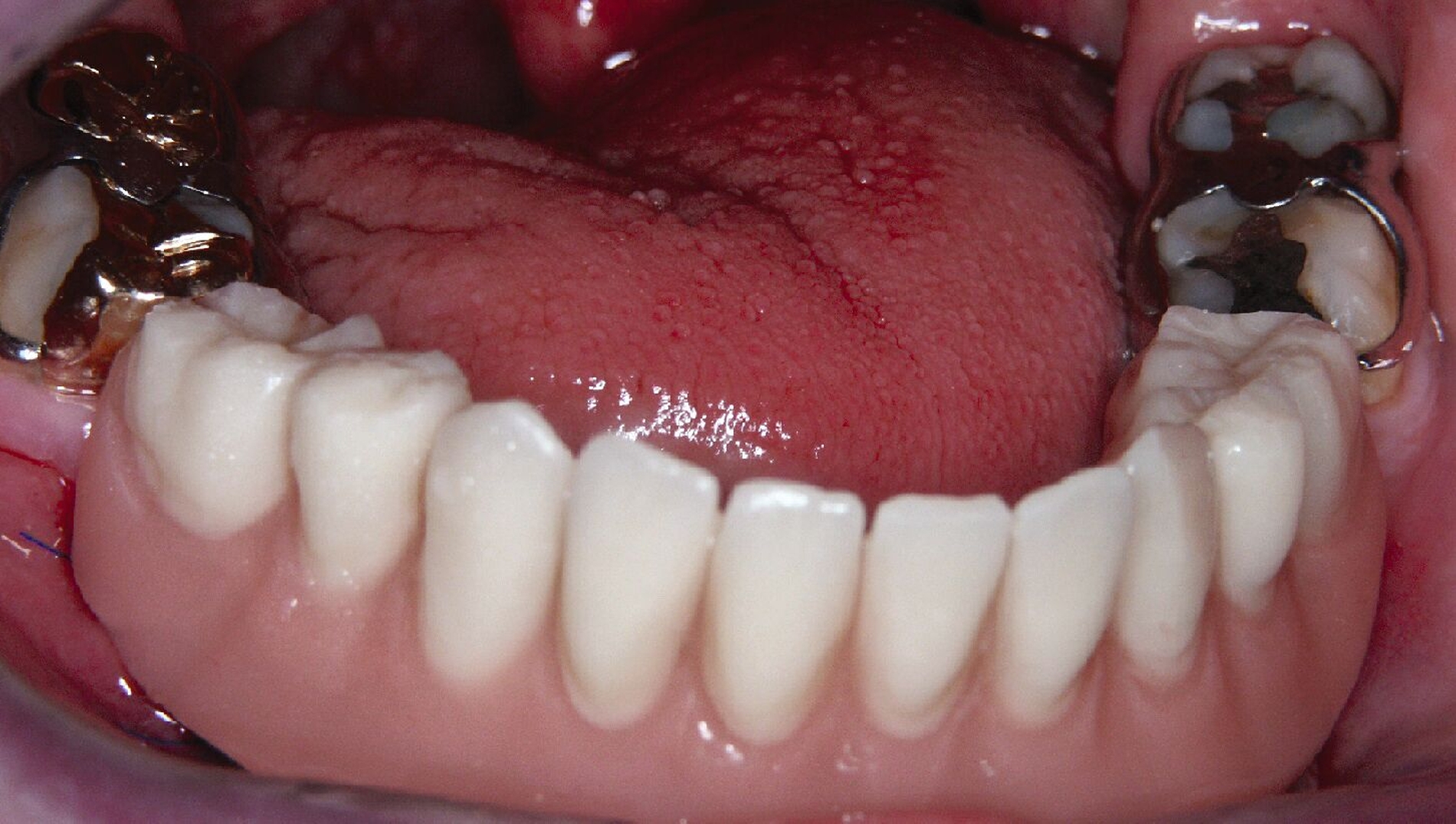 Abb. 1f: Die Interimsprothese wurde mit gegossenen Bonwill-Klammern an den verbleibenden Molaren abgestützt und dient als Verbandsplatte.