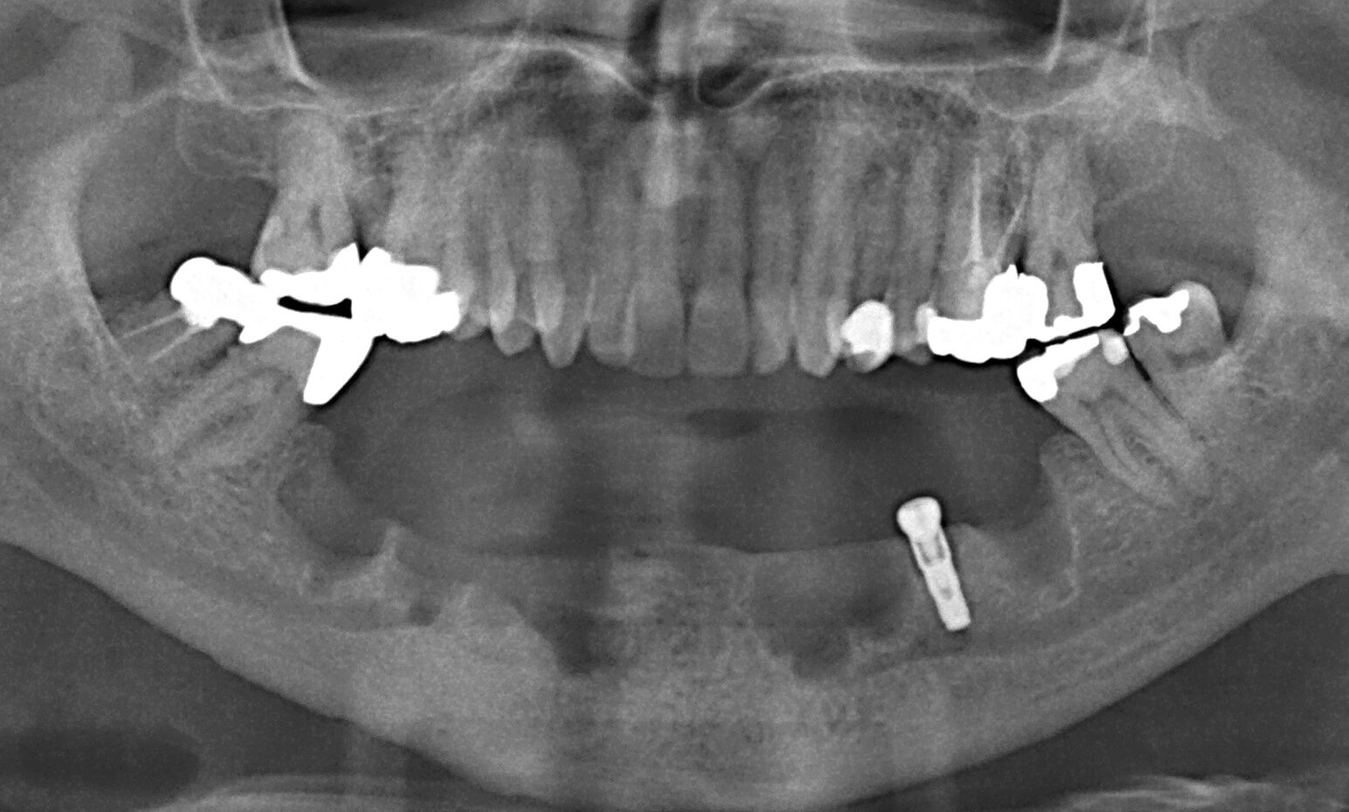 Abb. 1g: Das Implantat in regio 35 wurde zunächst erhalten, um das Abkippen der Interimsprothese und damit die frühzeitige Belastung des Kieferkamms zu vermeiden.
