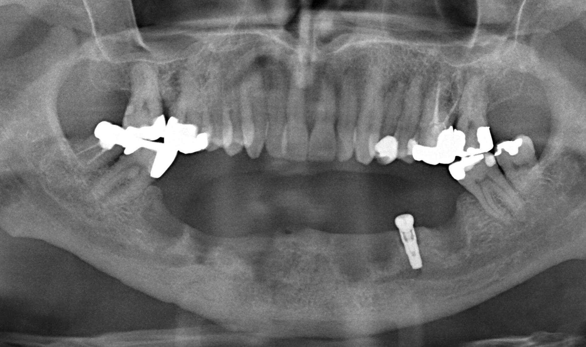Abb. 1h: Vier Monate nach Explantation zeigen sich deutliche Anzeichen einer knöchernen Regeneration im Bereich der explantierten Implantate.