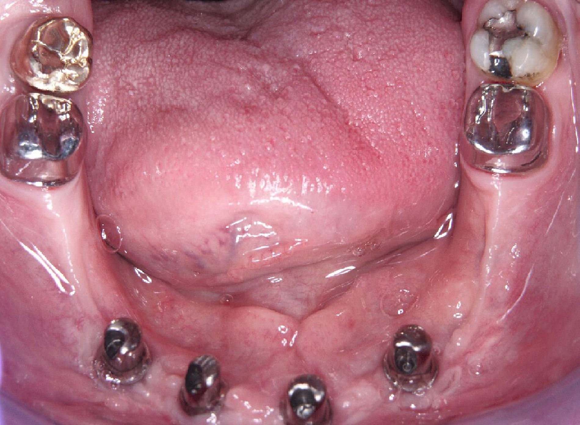 Abb. 1k: Zur optimalen Abstützung wurden zusätzlich 37 und 47 mit Primärteleskopen aus einer CoCr-Legierung versorgt. Die Primärteleskope auf 37 und 47 wurden zementiert und die Primärteleskope auf den Implantaten verschraubt.