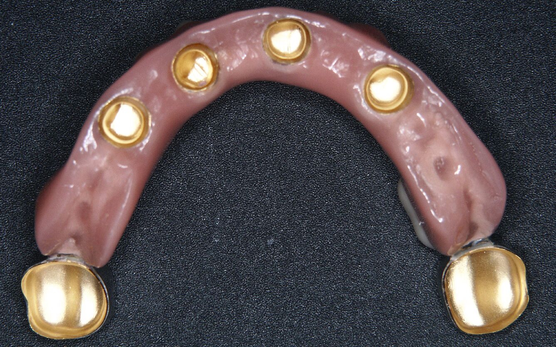 Abb. 1l: Die Sekundärteleskope wurden galvanisch aus Gold hergestellt und spannungsfrei intraoral verklebt.
