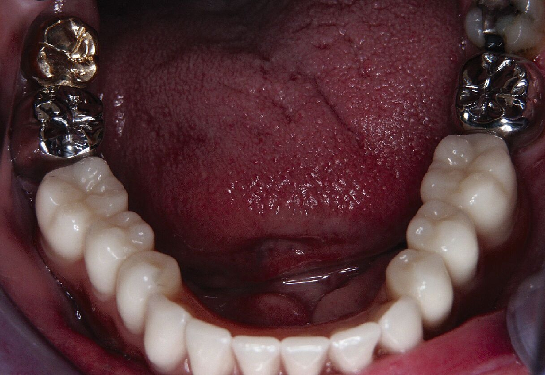 Abb. 1m: Eingesetzte Teleskopprothese in der Aufsicht (Prothetische Versorgung durch Prof. Dr. Thomas Stober und Dentallabor Plewe)