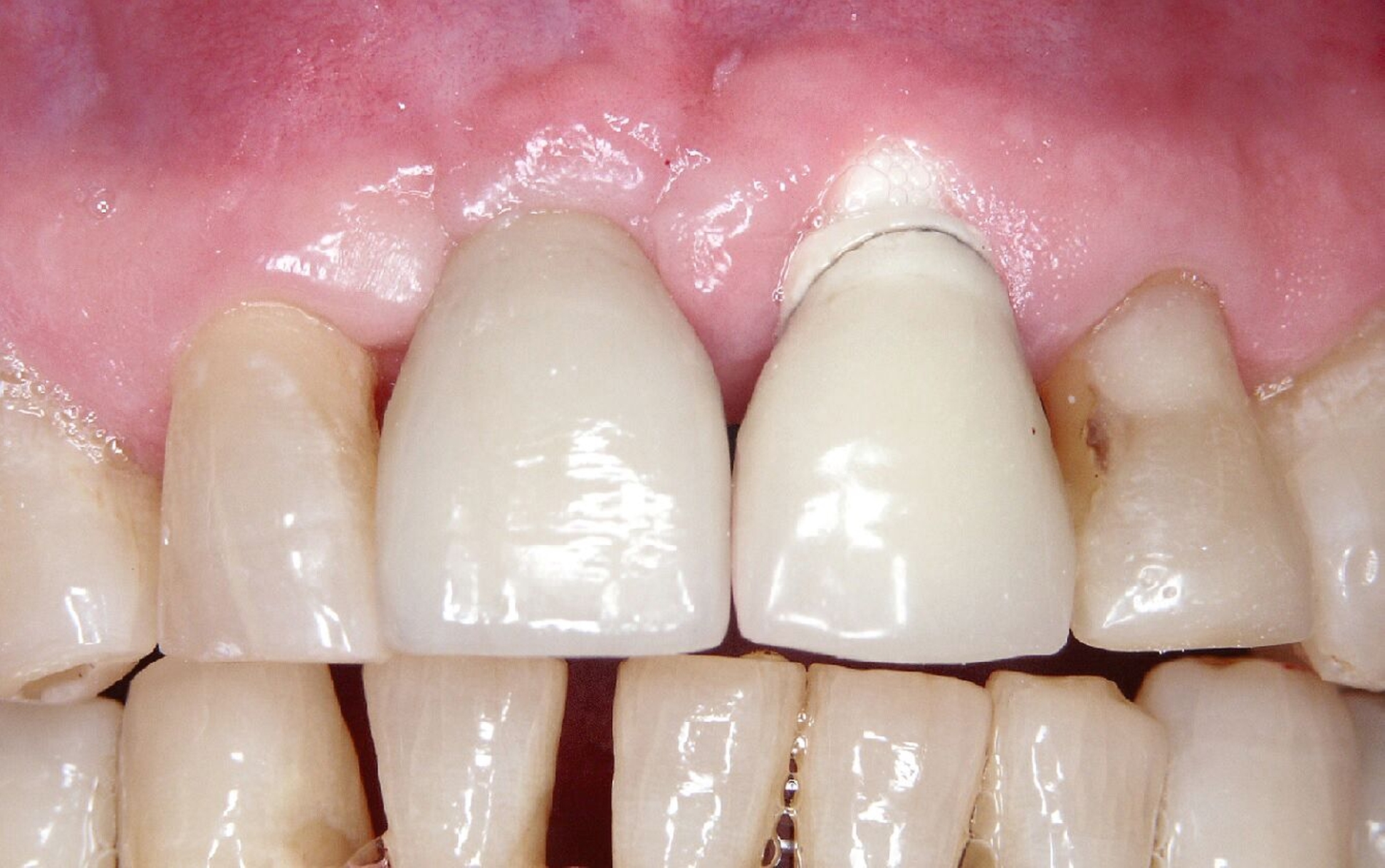 Abb. 2a: Implantatgestützte Einzelkronen 11 und 21: 21 circa 20 Jahre altes Tübinger Sofortimplantat mit Gingivarezession nach Verlust der bukkalen Knochenlamelle