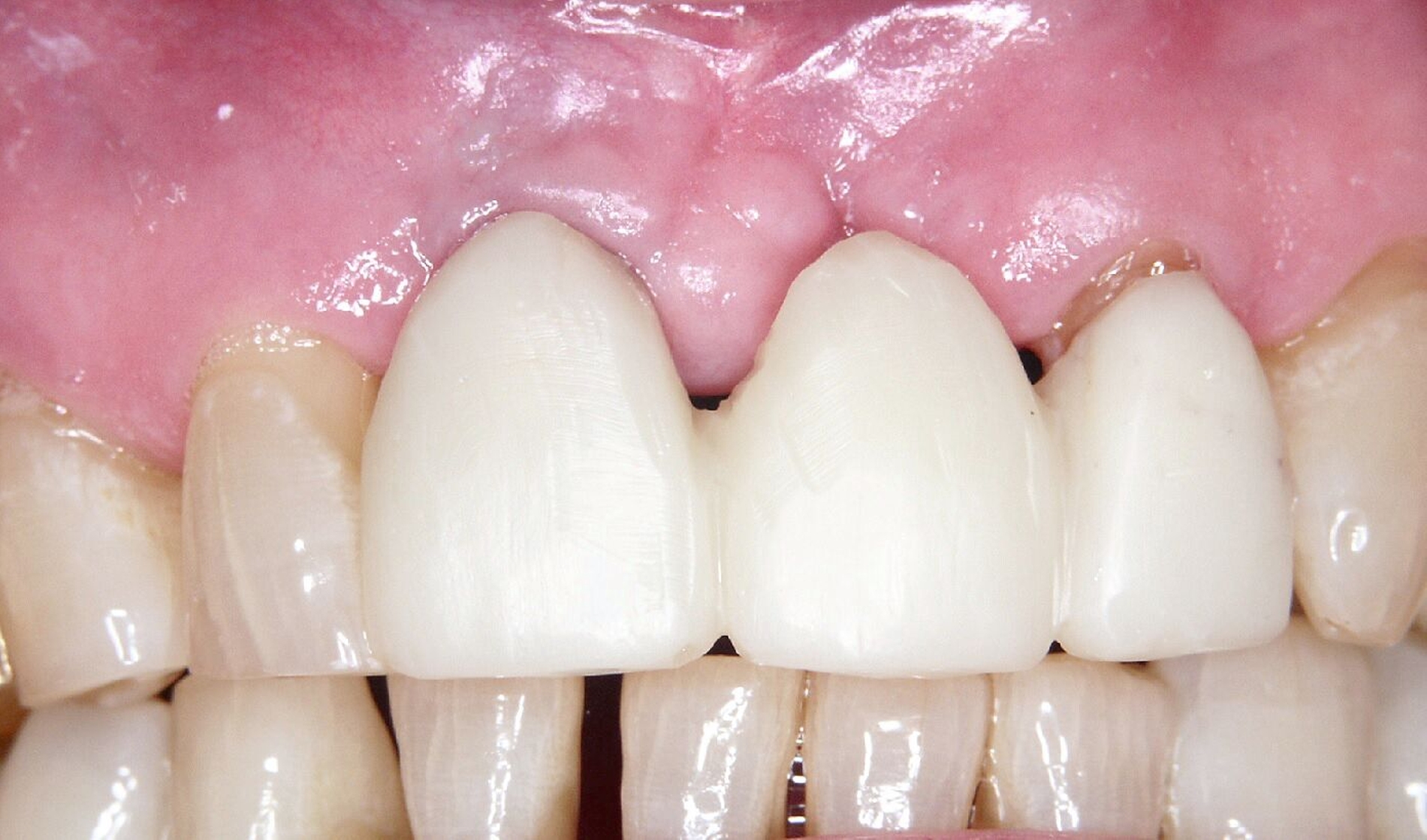 Abb. 2b: Nach Verlust des Implantats in regio 21 wurde die Krone 11 entfernt und ein stuhlgefertigtes Brückenprovisorium vom Implantat in regio 11 zum Zahn 22 eingesetzt.