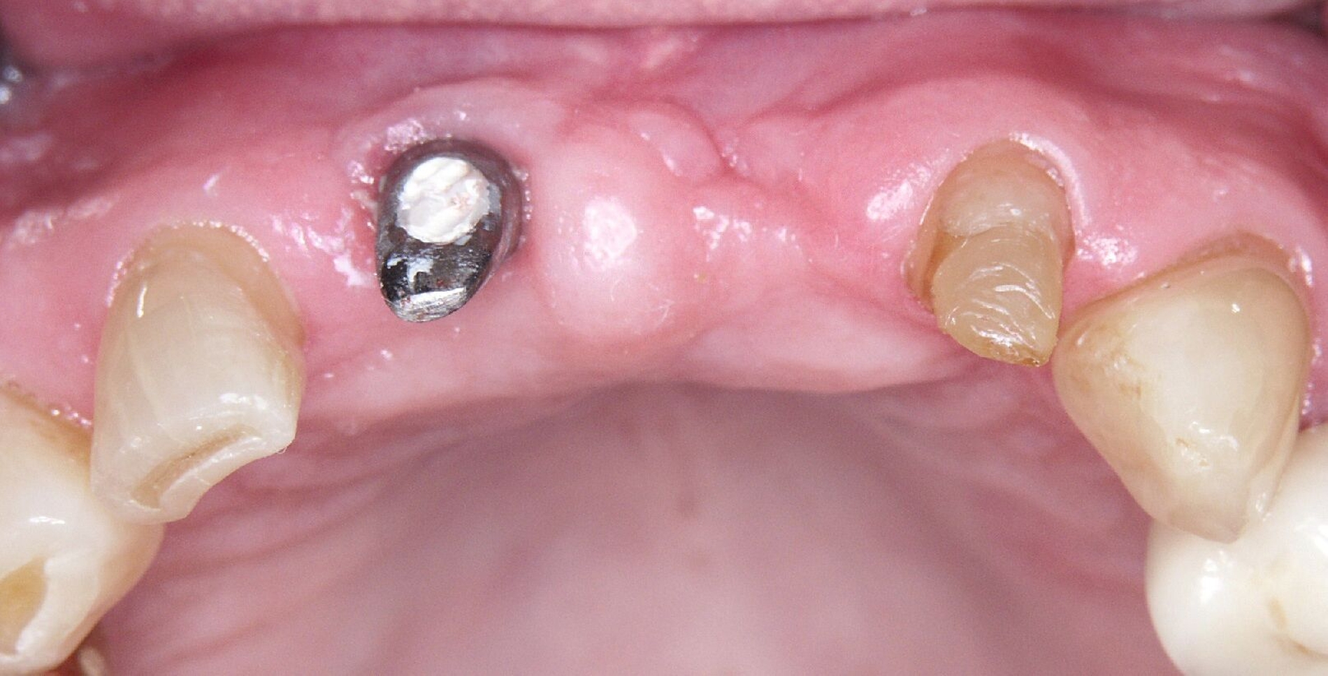 Abb. 2c: Aufgrund des Knochenverlusts verblieb drei Monate nach der Implantatentfernung ein Weichgewebsdefizit in regio 21 mit ausgeprägter Narbenbildung.