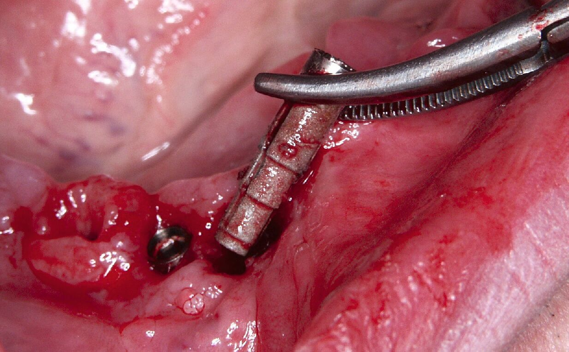 Abb. 1e: Die Implantatoberflächen waren weitgehend frei von Knochen.