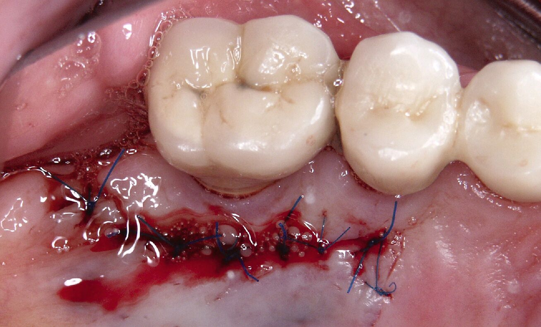 Abb. 2e: Entnahmestelle des BGW-Transplantats nach Nahtverschluss