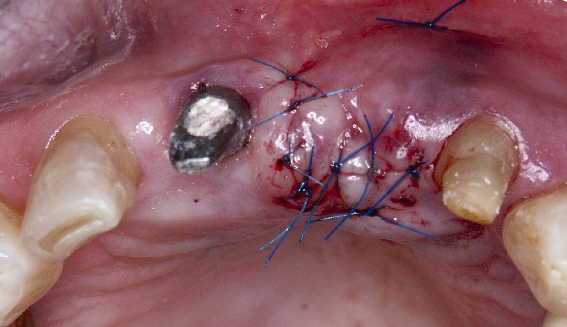 Abb. 2d: Zum Auffüllen des Weichgewebsdefizits wurde ein Bindegewebstransplantat submukös platziert.