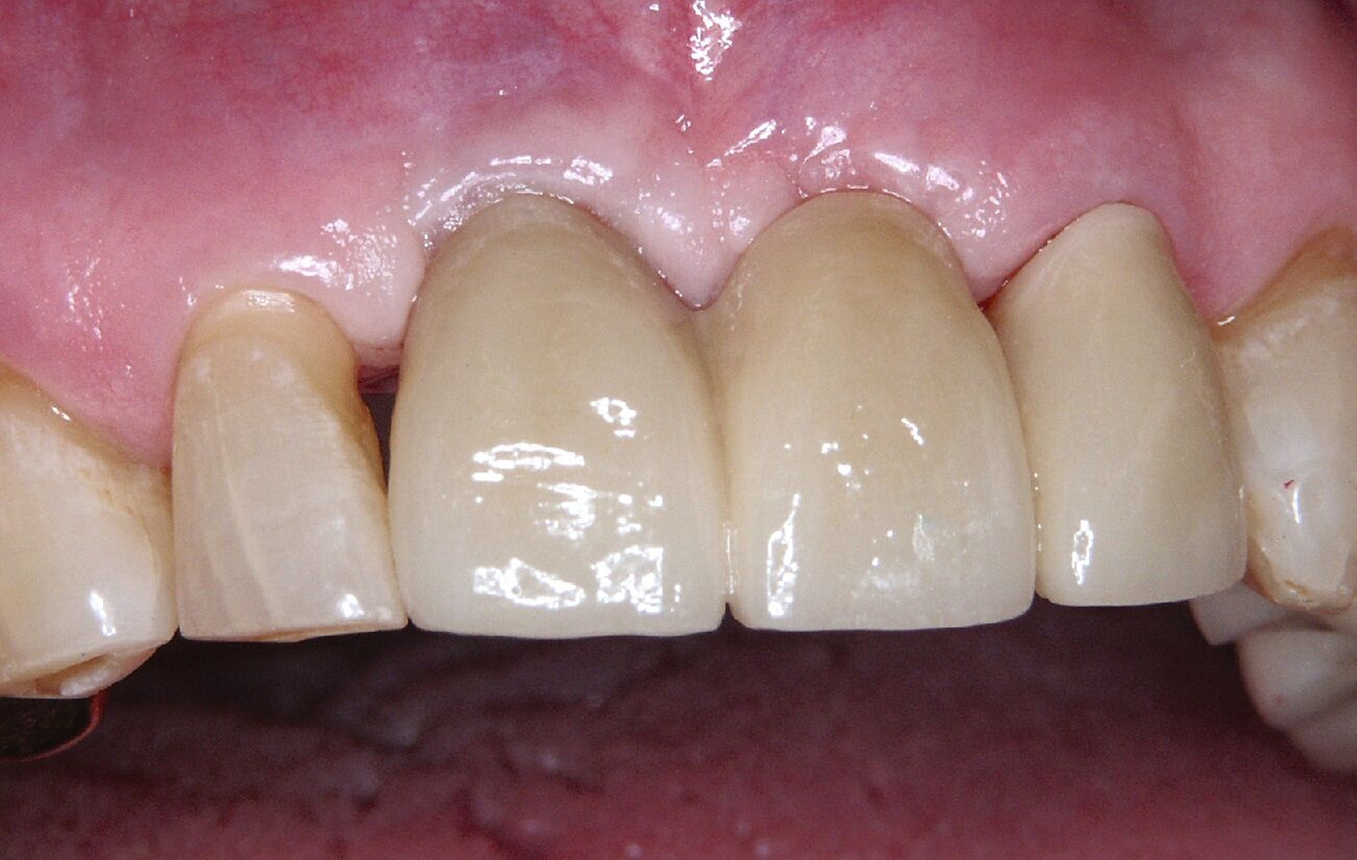 Abb. 2g: Nach Eingliederung einer Zahn-/Implantat-gestützten Brücke 11–22 mit ausreichend Weichgewebsangebot