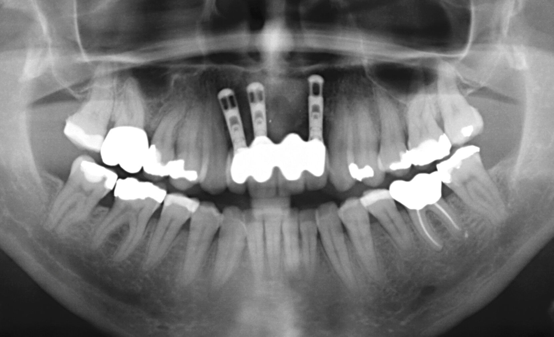 Abb. 3b: Die Panoramaaufnahme zeigt einen approximalen periimplantären Knochenabbau von zum Teil über 50 Prozent.