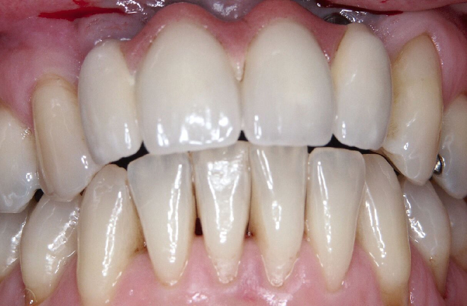 Abb. 3a: Implantatgestützte Frontzahnbrücke 15 Jahre nach der Versorgung: Zum Kaschieren des Hart- und Weichgewebsdefizits war gingivafarbene Keramik im Zervikalbereich aufgebrannt.