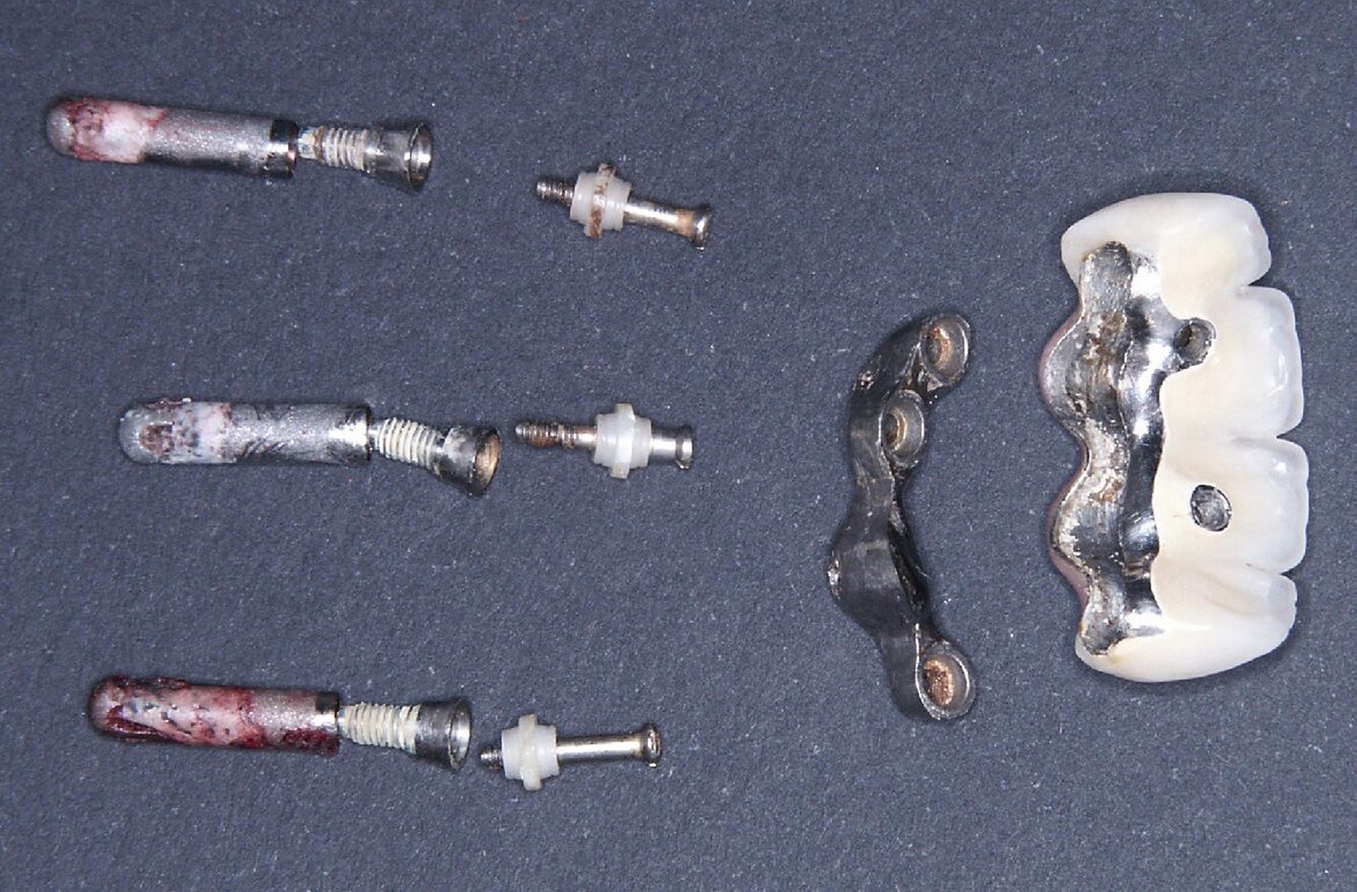 Abb. 3d: Die Verblendbrücke war mit der Mesostruktur horizontal verschraubt. Die explantierten Implantate sind mit bis zu 70 Prozent der Länge nicht mehr von Knochen bedeckt.