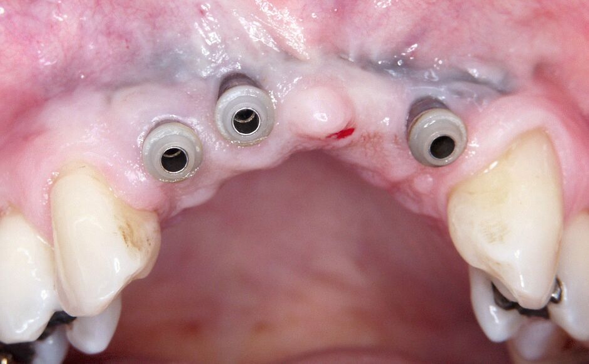 Abb. 3c: Trotz ausgeprägtem Knochenabbau von 30 bis 70 Prozent und Sondierungstiefen bis zu 9 mm zeigt die periimplantäre Gingiva nur eine geringe Blutungsneigung.