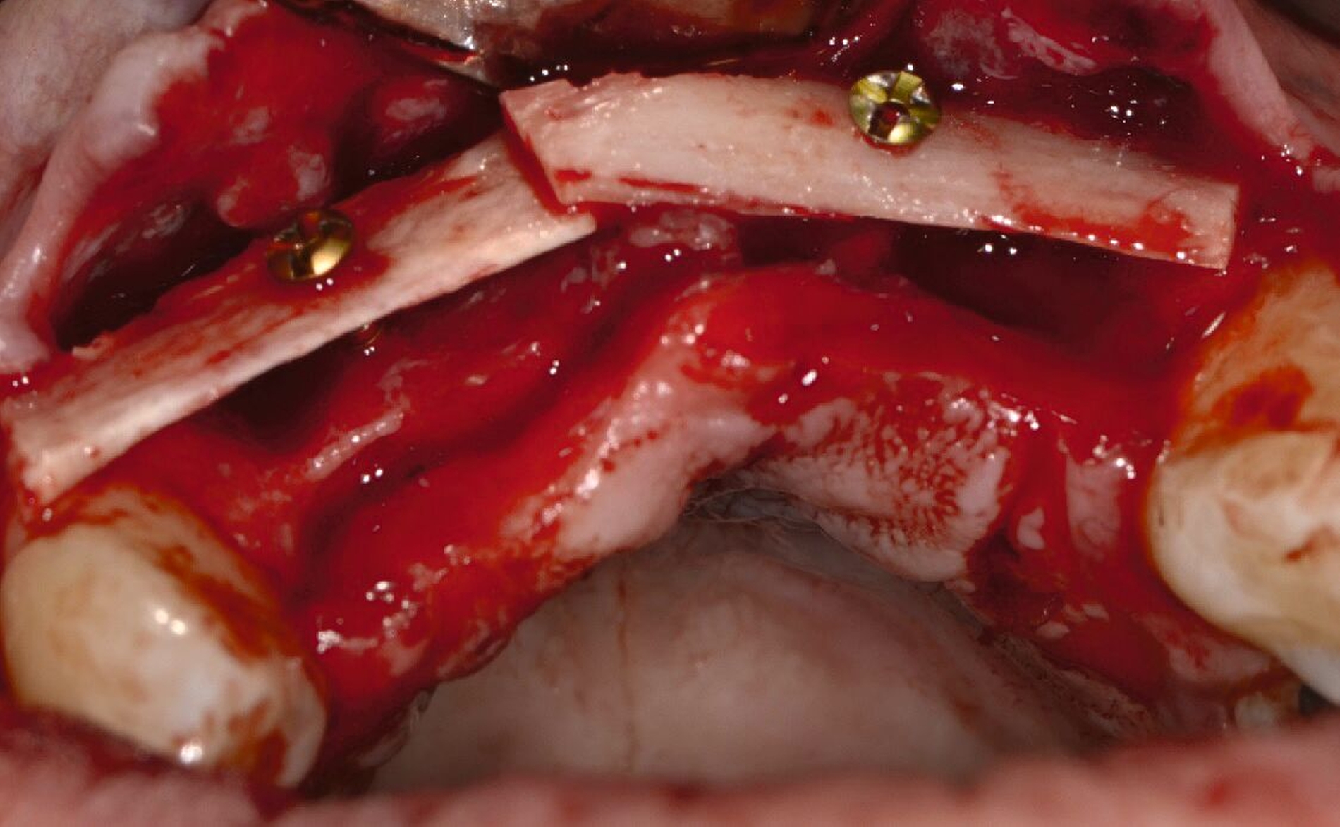 Abb. 3e: Verschraubung von Knochenplättchen aus dem aufsteigenden Unterkieferast am ortsständigen Restknochen mit 5 mm langen Osteosyntheseschrauben