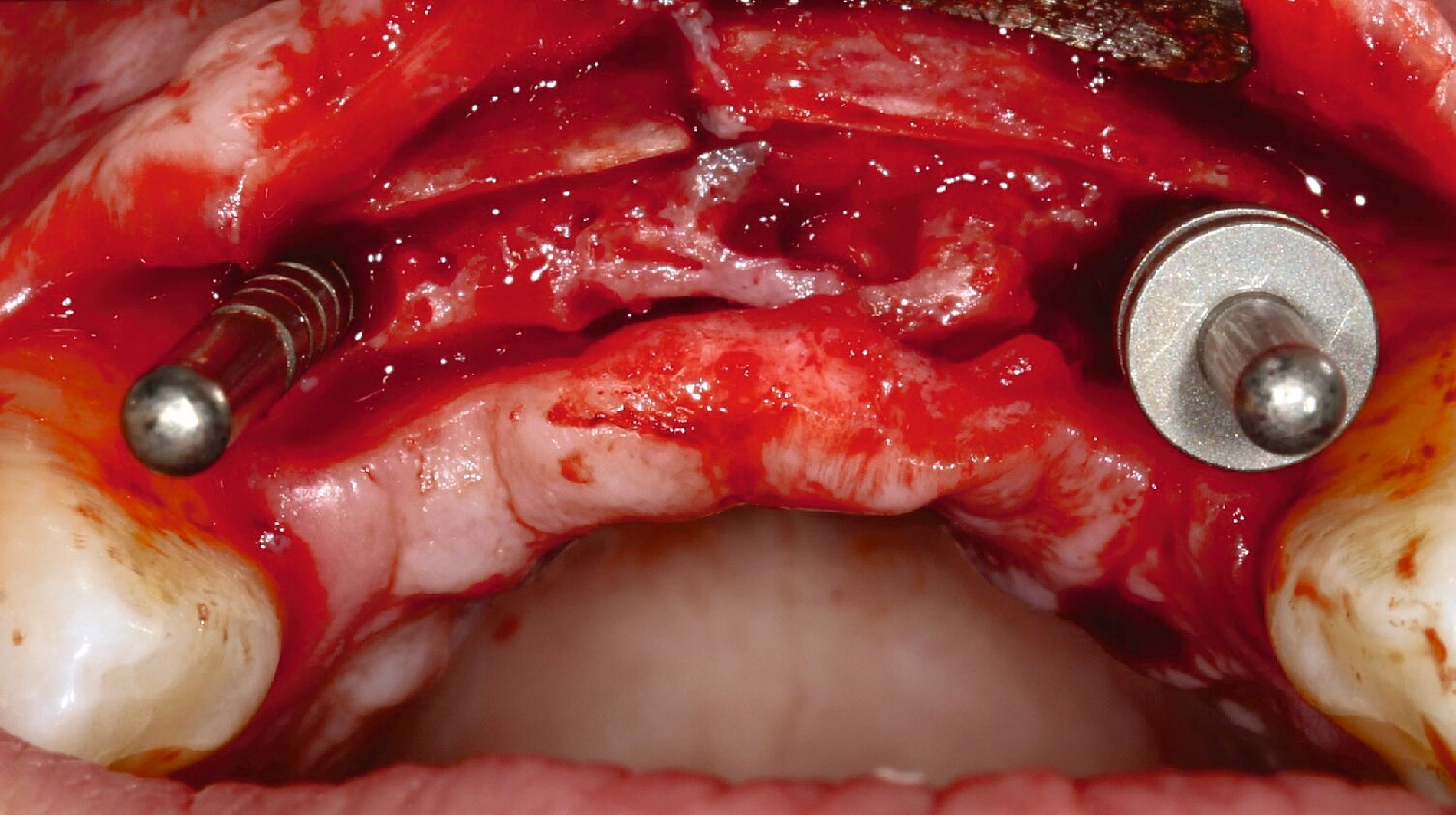 Abb. 3f: Bei Freilegung des Frontzahnsegments fünf Monate später sind die Transplantate bereits teilweise mit der Umgebung verwachsen. Nachimplantation in regio 12 und 22 (Richtungsindikatoren im Bohrstollen).