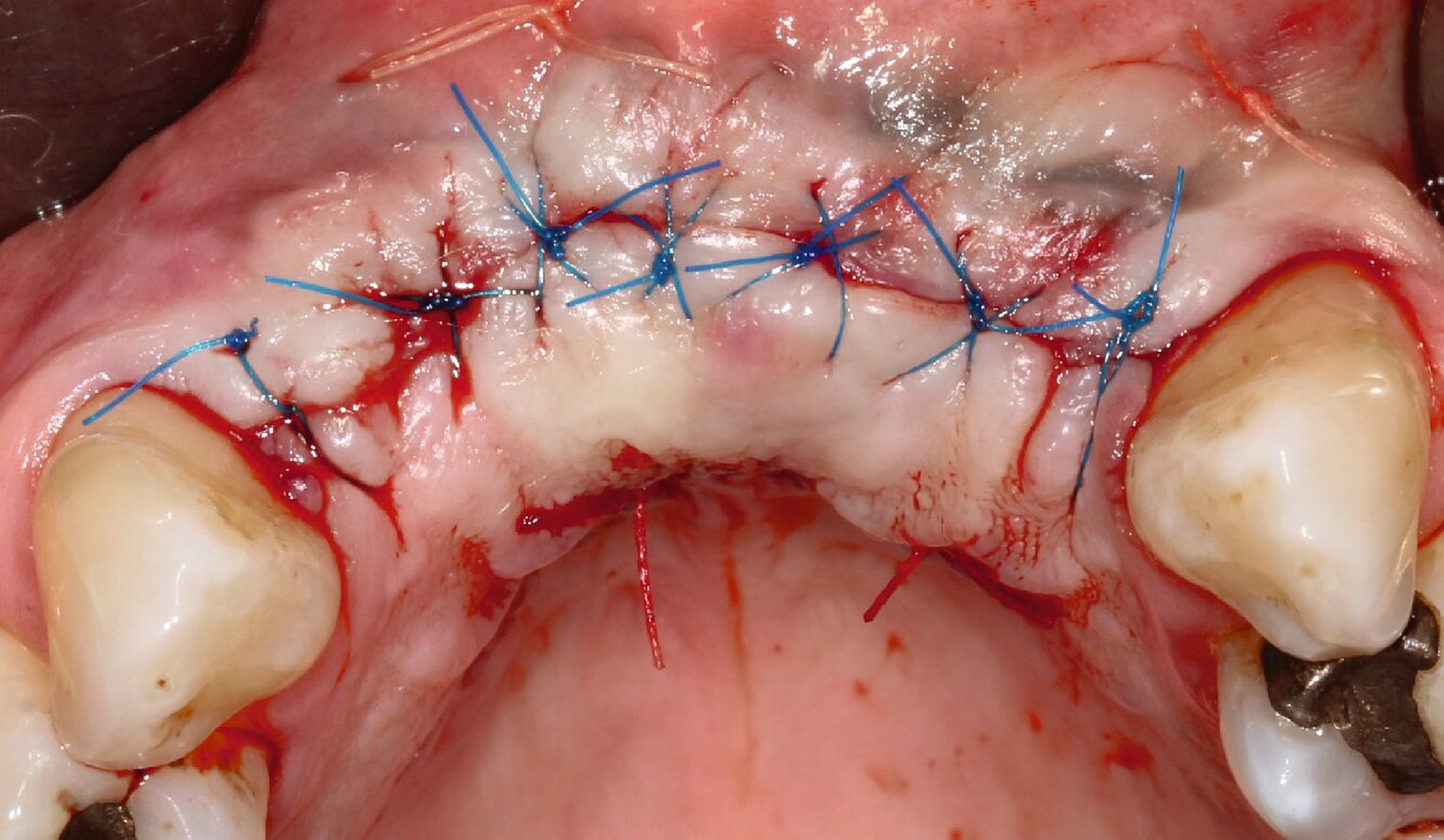 Abb. 3g: Dichter Nahtverschluss zur geschlossenen Einheilung der Implantate