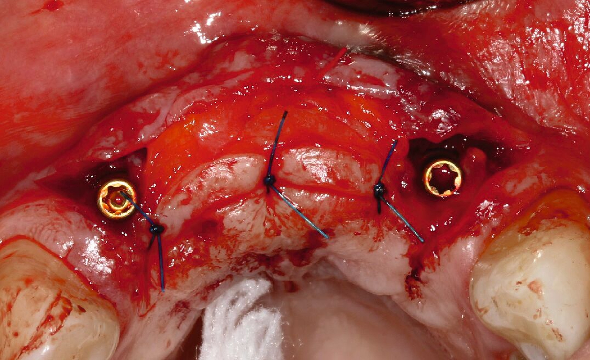 Abb. 3h: Nach sechsmonatiger Einheilung der Implantate Fixieren eines gemischten BGW/FST-Transplantats aus dem Gaumen zur Verbreiterung der keratinisierten Gingiva und zum Auffüllen des Weichgewebsdefizits im künftigen Brückengliedbereich