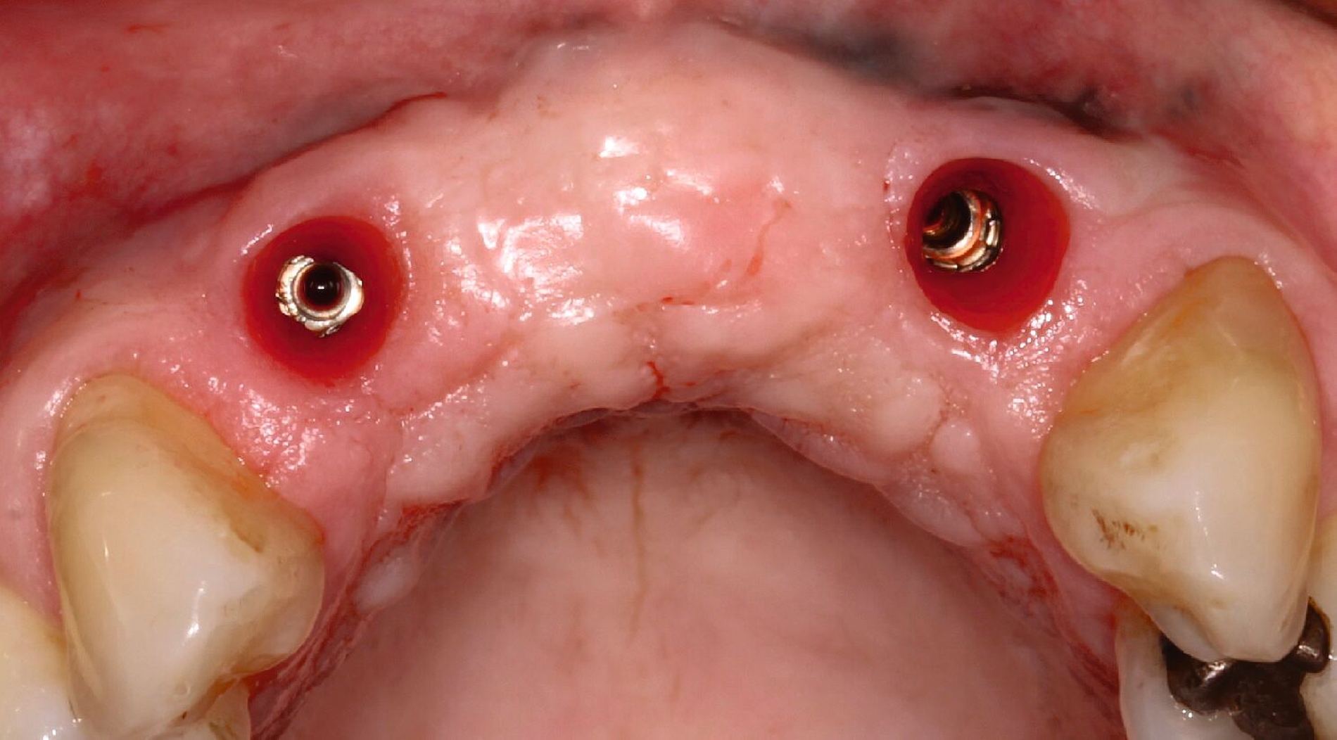 Abb. 3j: Konsolidierte Weichgewebsverhältnisse nach weiteren drei Monaten