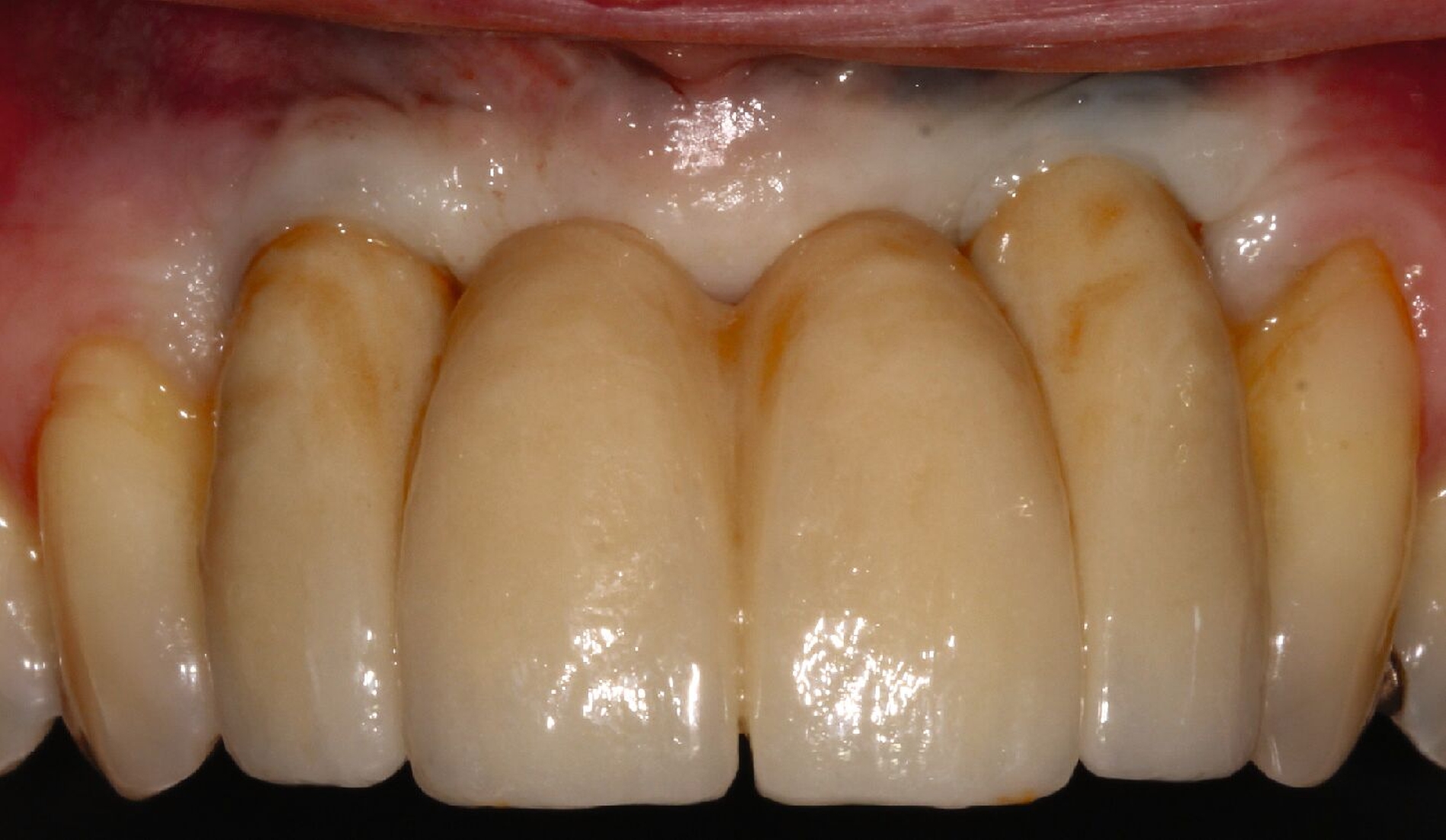 Abb. 3k: Eingesetzte vollkeramische Brücke mit langen klinischen Kronen, jedoch ohne rosafarben überbrannte Zahnhälse.