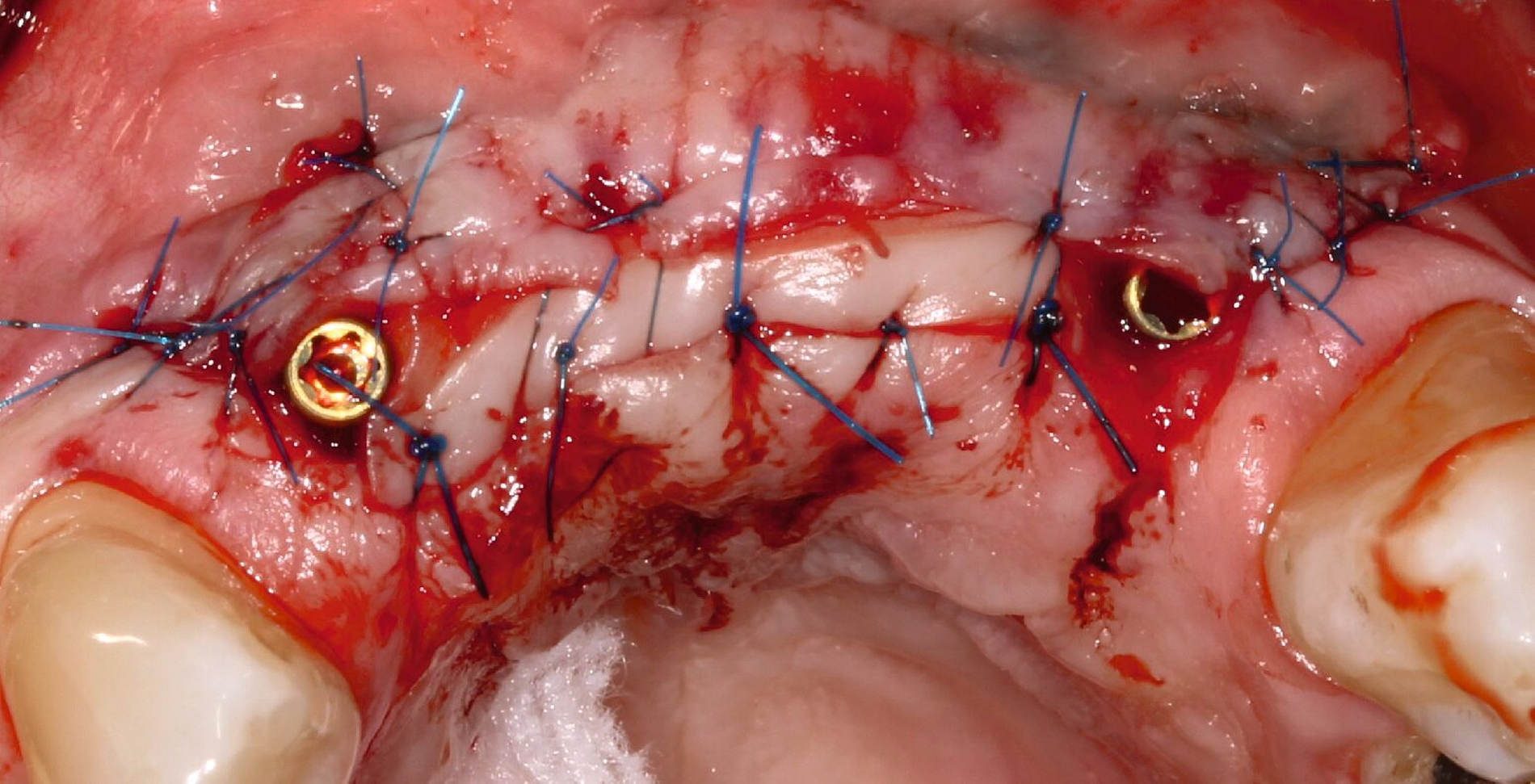 Abb. 3i: Situation nach komplettem Nahtverschluss
