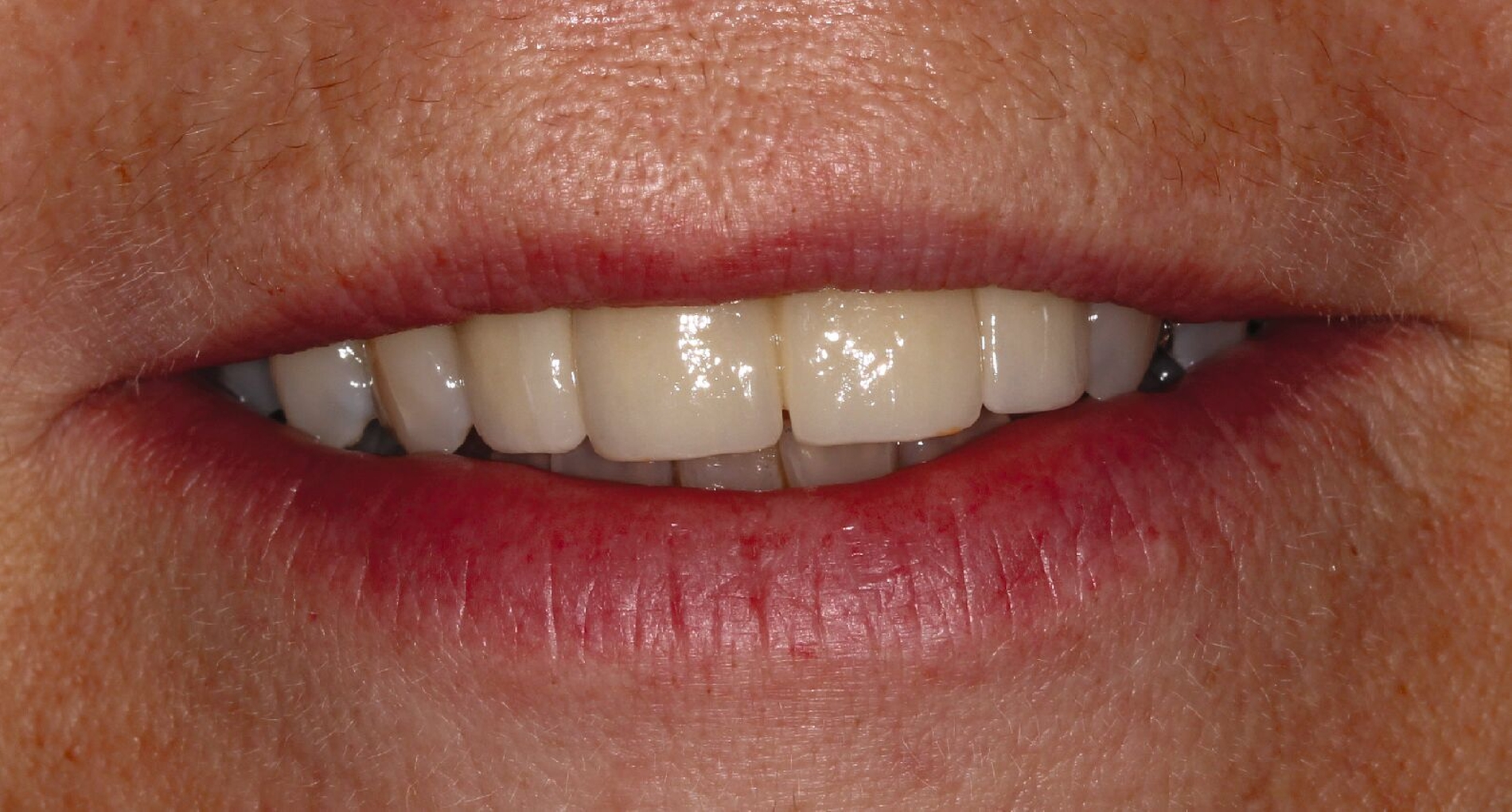 Abb. 3l: Lippenbild mit eingesetzter Brücke 12–22