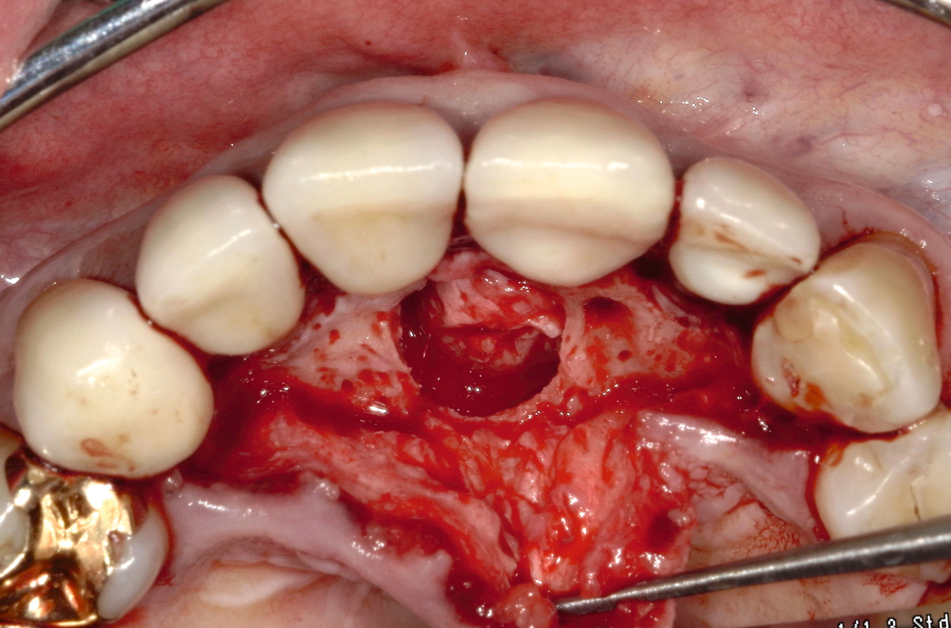 Abb. 3: Intraoperatives Bild mit dargestellter Nasopalatinuszyste