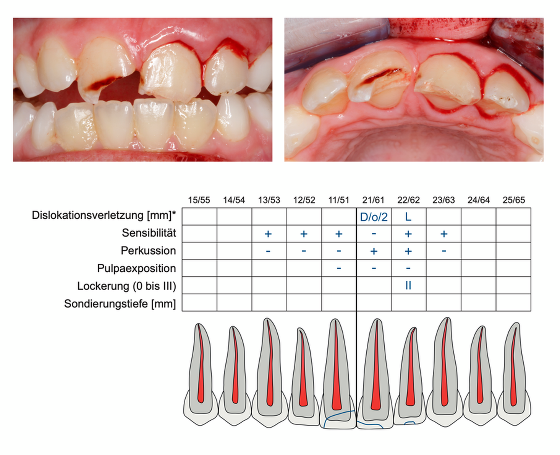 Abb. 6: Beispieldokumentation eines Zahnunfalls. Es handelt sich um eine Schmelz-Dentin-Fraktur ohne Pulpabeteiligung und eine Schmelzfraktur an den Zähnen 21 und 22. Zusätzlich besteht eine Dislokation des Zahnes 21 um 2 mm nach oral und der Zahn 22 ist gelockert.