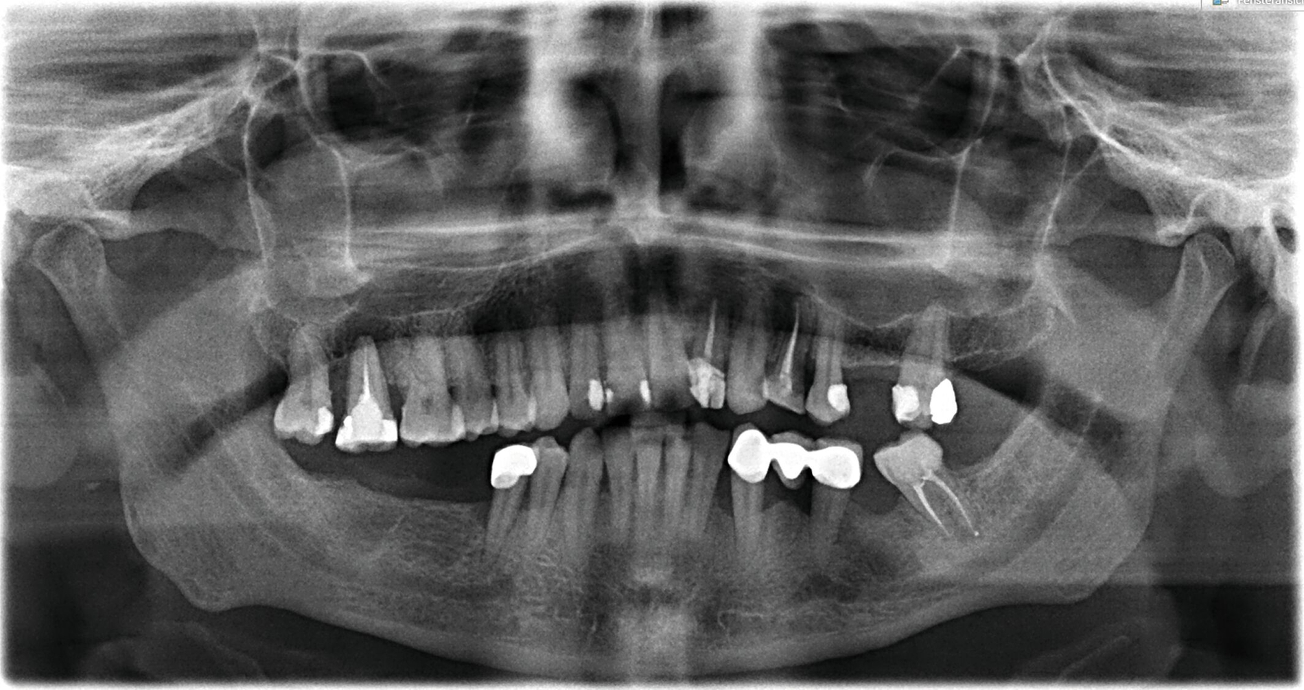 Abbildung 2: Präoperatives OPG von 2022 mit sichtbarer Vergrößerung der Zysten in beiden Kieferhöhlen.